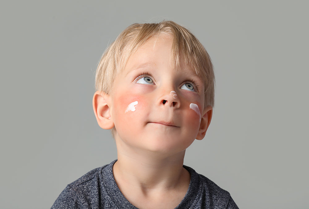 Home Remedies for Kids' Sunburns